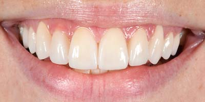 Vergleichsbild: Nach der Behandlung von Dr. Reek – Zahnarzt in Linz.