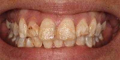 Vergleichsbild: Vor der Behandlung von Dr. Reek – Zahnarzt in Linz.