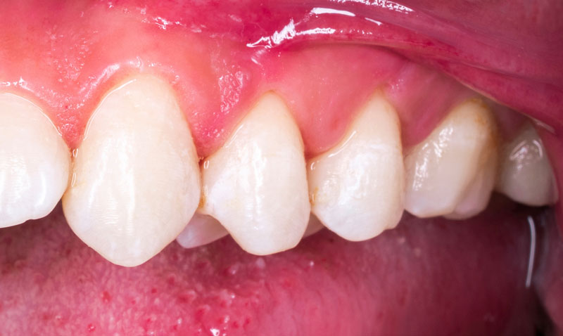 Zähne nach einer Zahnaufhellung-Behandlung.