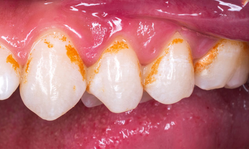 Zähne vor einer Behandlung der Zahnaufhellung.