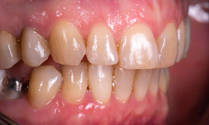 Schöne Zähne nach einer ästhetischen rekonstruktiven Zahnbehandlung.