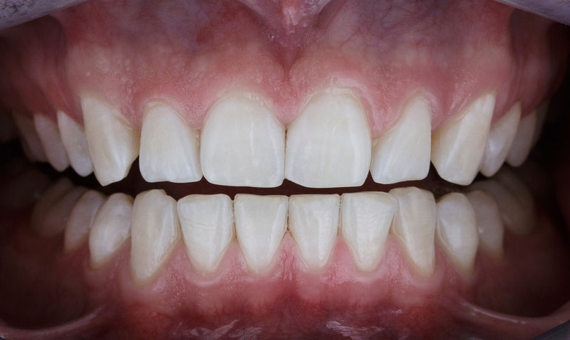 Zahnaufhellung (Bleaching) wird von der Zahnarztpraxis Dr. Reek & Dr. Reek angeboten.