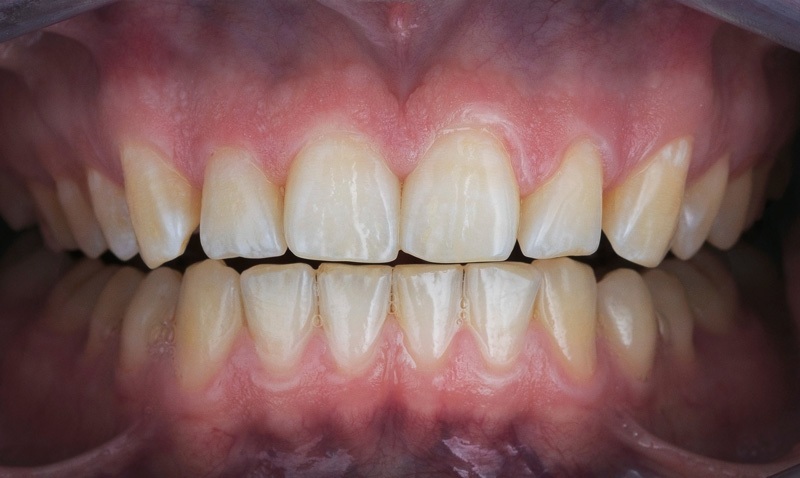 Zähne vor einer ästhetischen rekonstruktiven Zahnbehandlung.